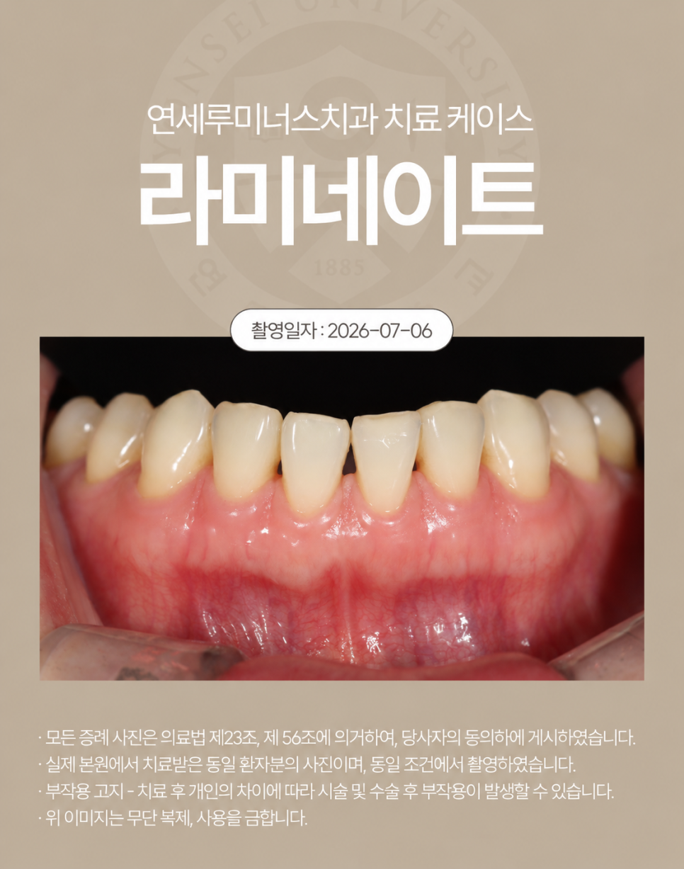 강남라미네이트 / 상악 라미네이트에 이어 하악까지! 완벽 보완 관련 이미지 5
