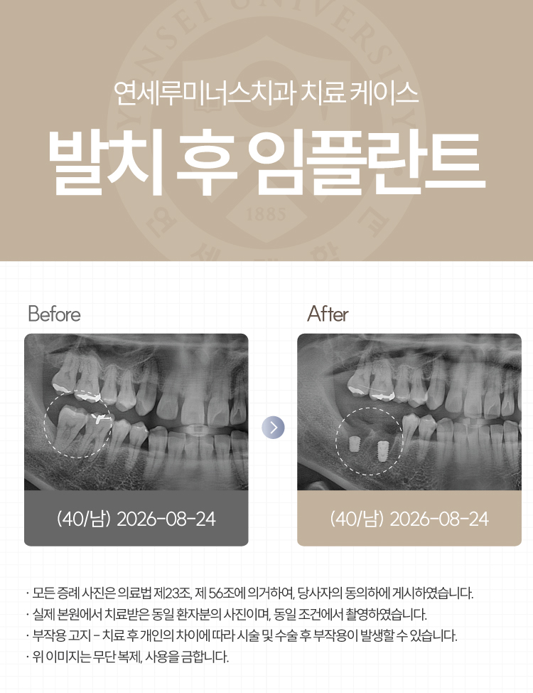 강남발치후임플란트 케이스 - 심한 치주질환으로 인한 발치 후 즉시 임플란트 (40대/남환자) 관련 이미지 1
