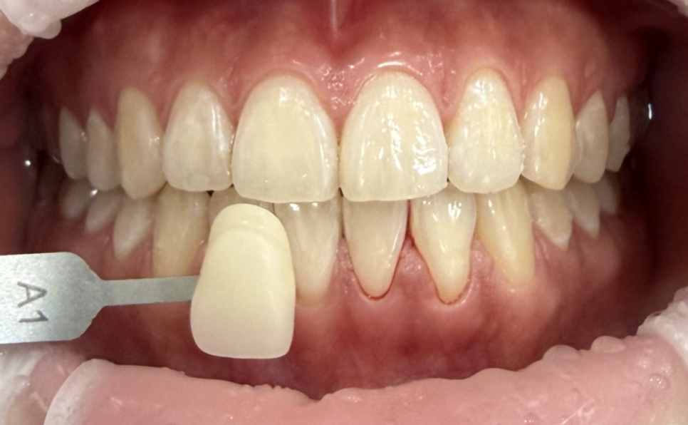 A Patient Came in for Whitening Again Today~~ image 2