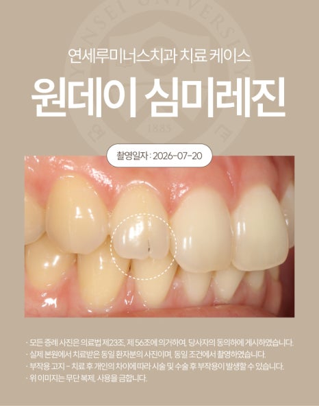 강남심미레진 치료사례 ― #12 앞니 심미레진 원데이 케이스 (30세/여환자) 관련 이미지 3