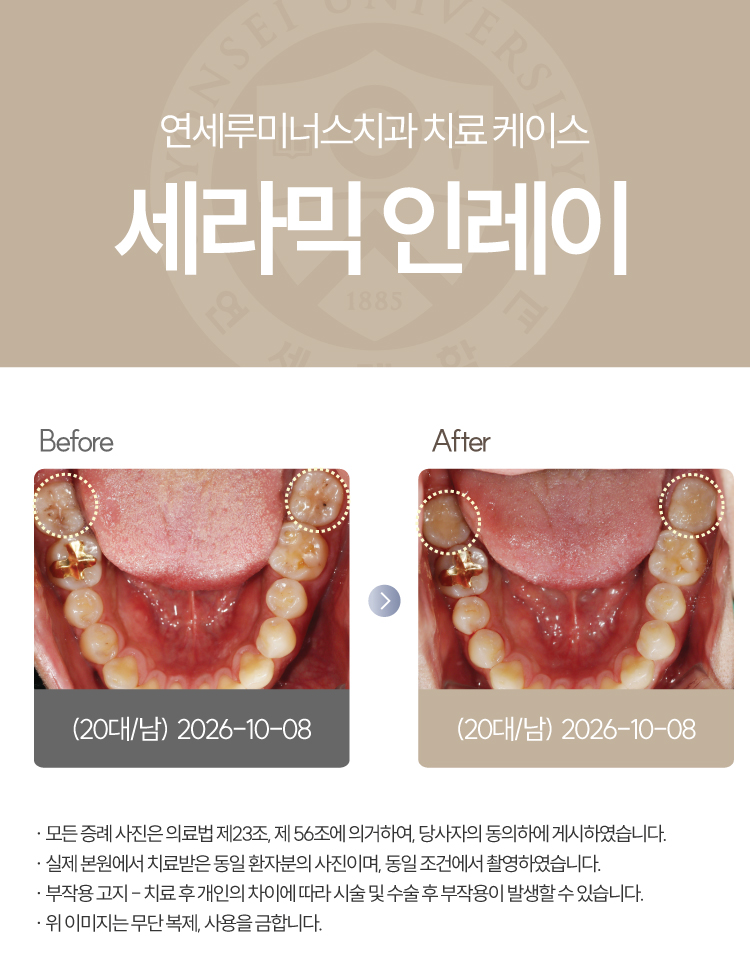 강남충치치료 케이스 : 직장동료 추천으로 내원한 20대 남성, 4개 세라믹 인레이 관련 이미지 5