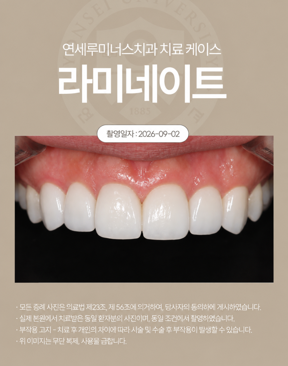 강남라미네이트 / 치아의 작은 디테일까지 고려한 심미 라미네이트 관련 이미지 3