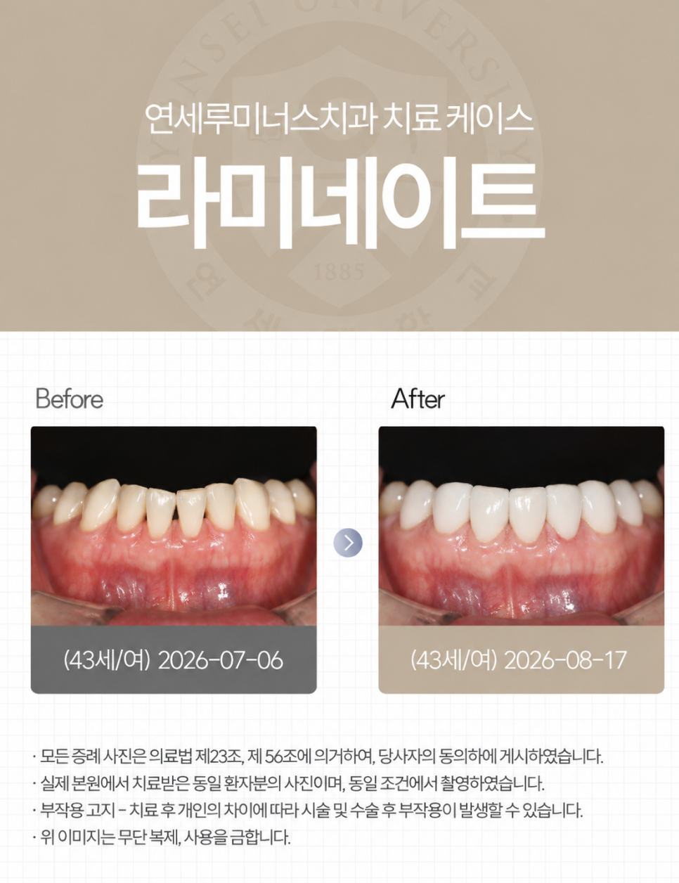 강남라미네이트 / 상악 라미네이트에 이어 하악까지! 완벽 보완 관련 이미지 4