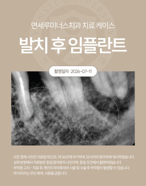강남발치후임플란트 사례 ― 좌측 상하악 다발성 발치 및 즉시 임플란트 식립 (52세/남환자) 관련 이미지 3