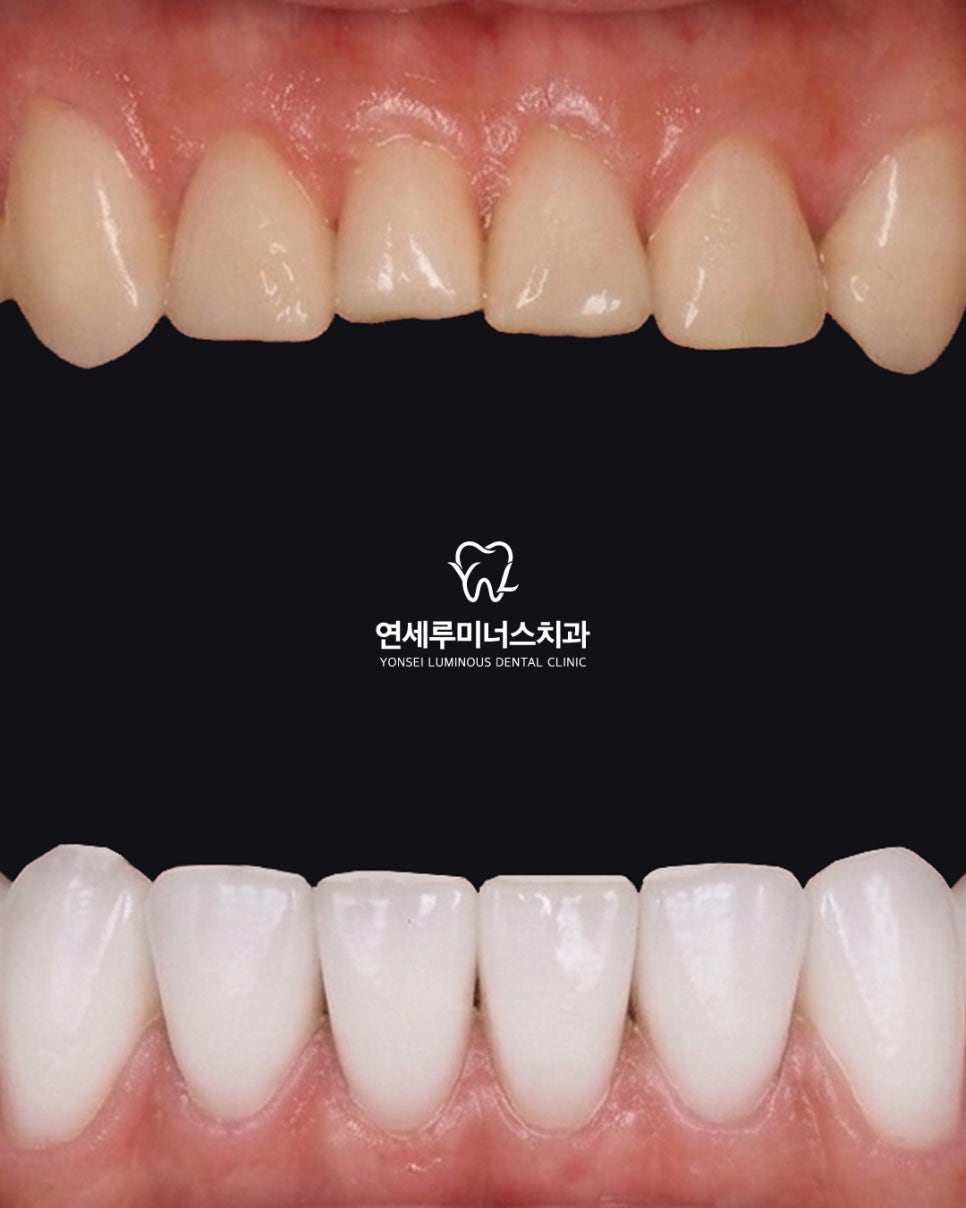 Laminates Are Still the Best, Yonsei Luminous Dental Clinic!! image 1