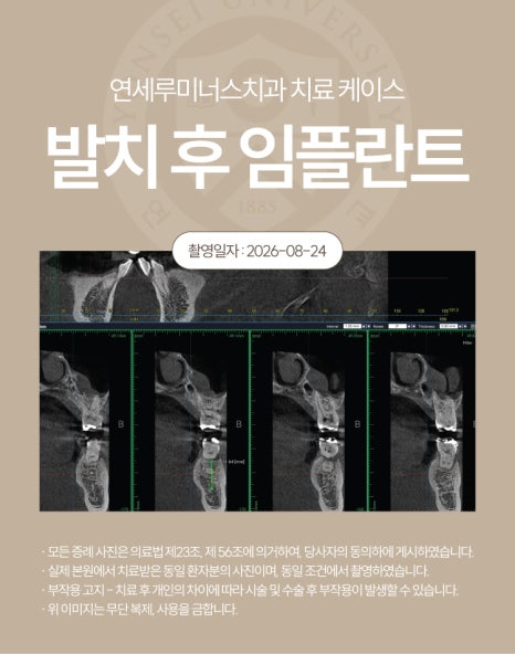 강남발치후임플란트 케이스 - 심한 치주질환으로 인한 발치 후 즉시 임플란트 (40대/남환자) 관련 이미지 4