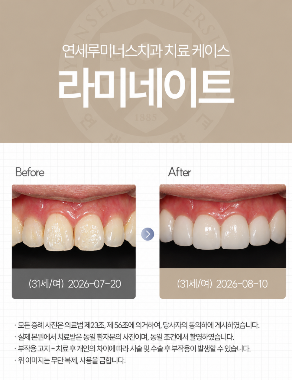 사진을 찍을 때 신경 쓰였던 치아, 라미네이트로 자연스럽게 변화 관련 이미지 1