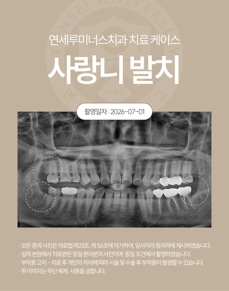 Gangnam Station Wisdom Tooth Extraction Case ― Simultaneous Extraction of Three Wisdom Teeth (21-Year-Old Female Patient) image 3