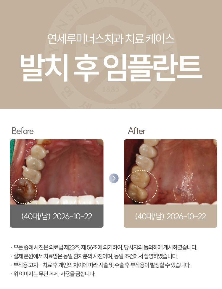 강남신경치료 케이스 : 사랑니까지 살린 17, 18번 치근단염 치료 (터키에서 오신 외국인 환자분!) 관련 이미지 1