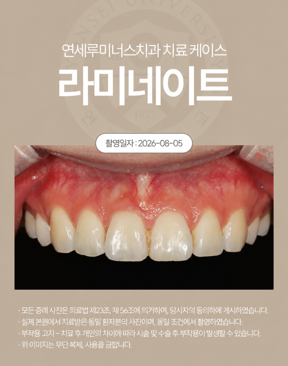 강남라미네이트 / 작고 어두운 치아, 자연스럽게 개선한 사례 관련 이미지 2