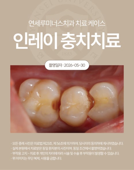 강남충치치료 사례 ― 좌측 어금니 통증으로 발견(28세/남환자) 관련 이미지 3