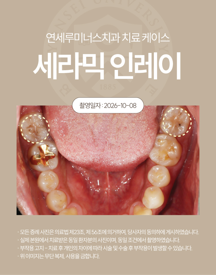 강남충치치료 케이스 : 직장동료 추천으로 내원한 20대 남성, 4개 세라믹 인레이 관련 이미지 1