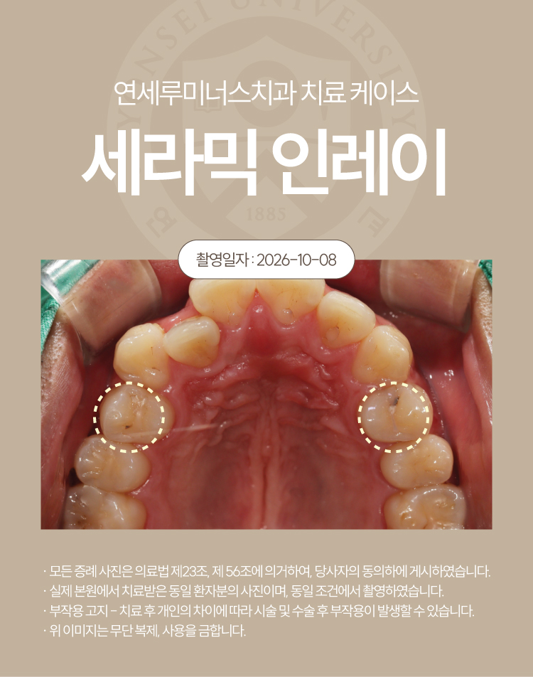 강남충치치료 케이스 : 직장동료 추천으로 내원한 20대 남성, 4개 세라믹 인레이 관련 이미지 2