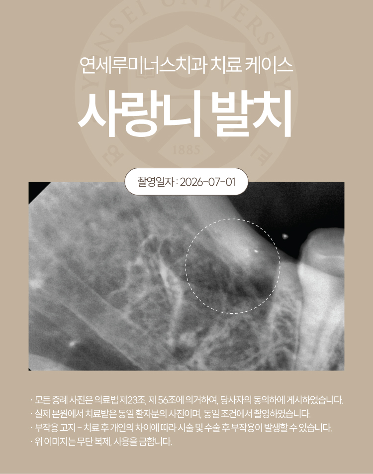 Gangnam Station Wisdom Tooth Extraction Case ― Simultaneous Extraction of Three Wisdom Teeth (21-Year-Old Female Patient) image 5