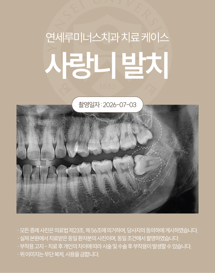 강남역사랑니발치 치료사례 ― 베트남 환자, 응급 내원 매복 사랑니 발치 케이스(10분 내 분할 발치 완료) 관련 이미지 2