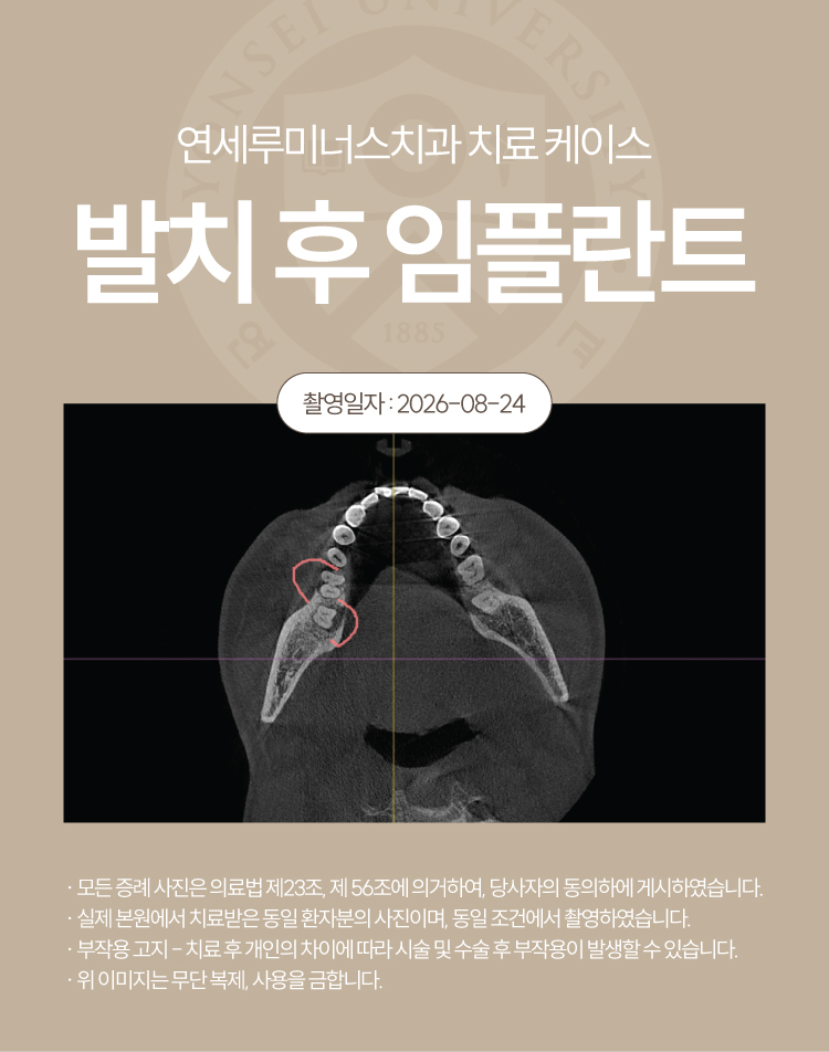 강남발치후임플란트 케이스 - 심한 치주질환으로 인한 발치 후 즉시 임플란트 (40대/남환자) 관련 이미지 3