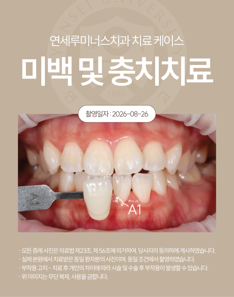 강남역치아미백 케이스 : 미백 중 발견한 충치까지 함께! (30대/여환자) 관련 이미지 6