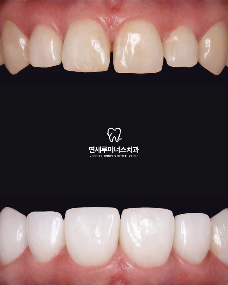 라미네이트 새로운 증례 관련 이미지 1