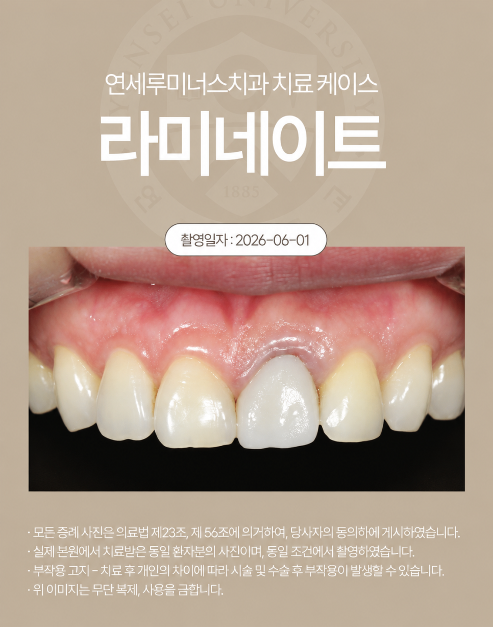 강남라미네이트 / 상악 라미네이트에 이어 하악까지! 완벽 보완 관련 이미지 2