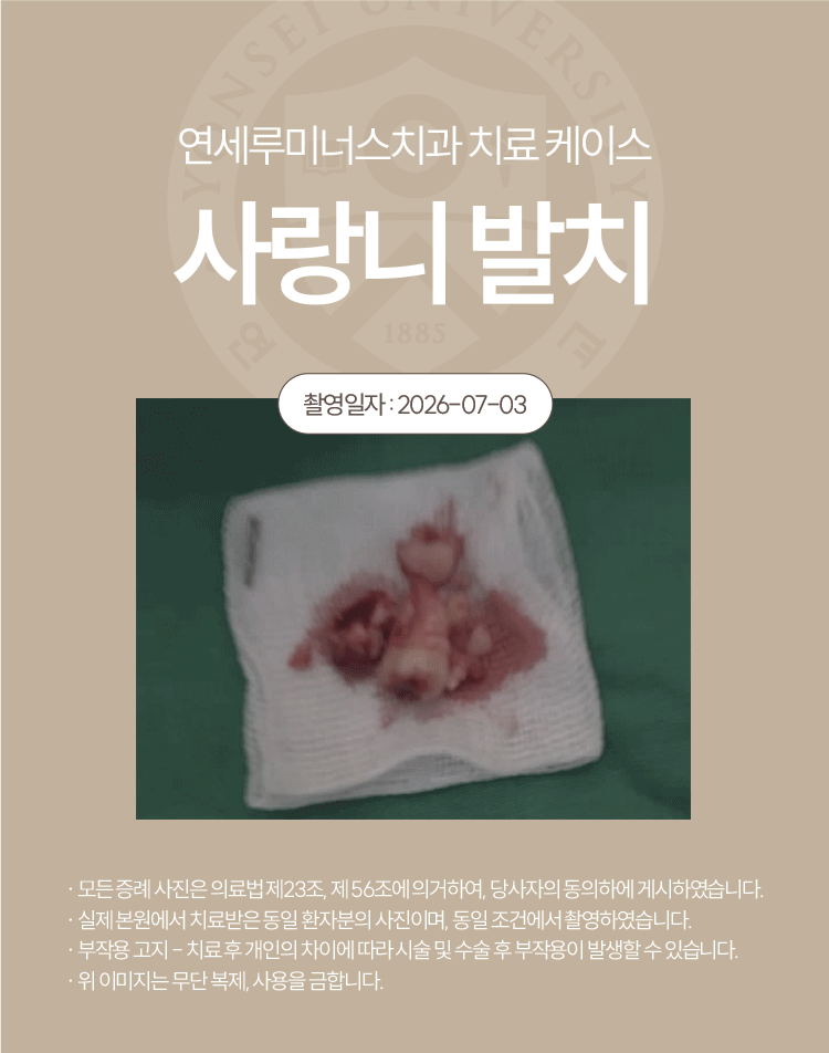 강남역사랑니발치 치료사례 ― 베트남 환자, 응급 내원 매복 사랑니 발치 케이스(10분 내 분할 발치 완료) 관련 이미지 6