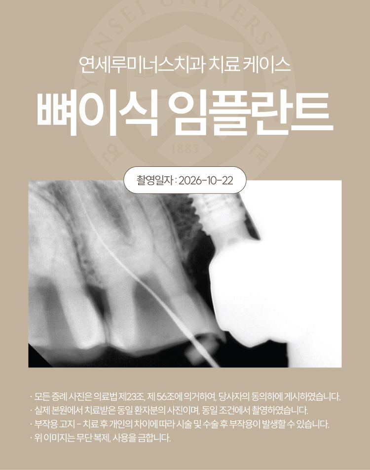 강남신경치료 케이스 : 사랑니까지 살린 17, 18번 치근단염 치료 (터키에서 오신 외국인 환자분!) 관련 이미지 5