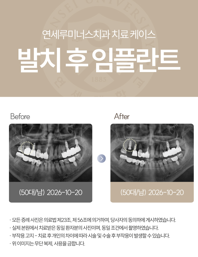 강남발치후임플란트 케이스 : 오른쪽 위 잇몸 붓기로 발견한 뿌리 염증, 발치 후 식립 관련 이미지 1
