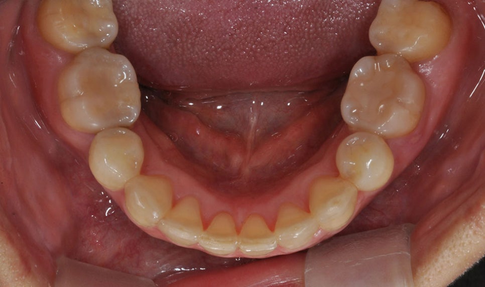 논현동치아교정치과 고른 치아를 위해서 관련 이미지 5