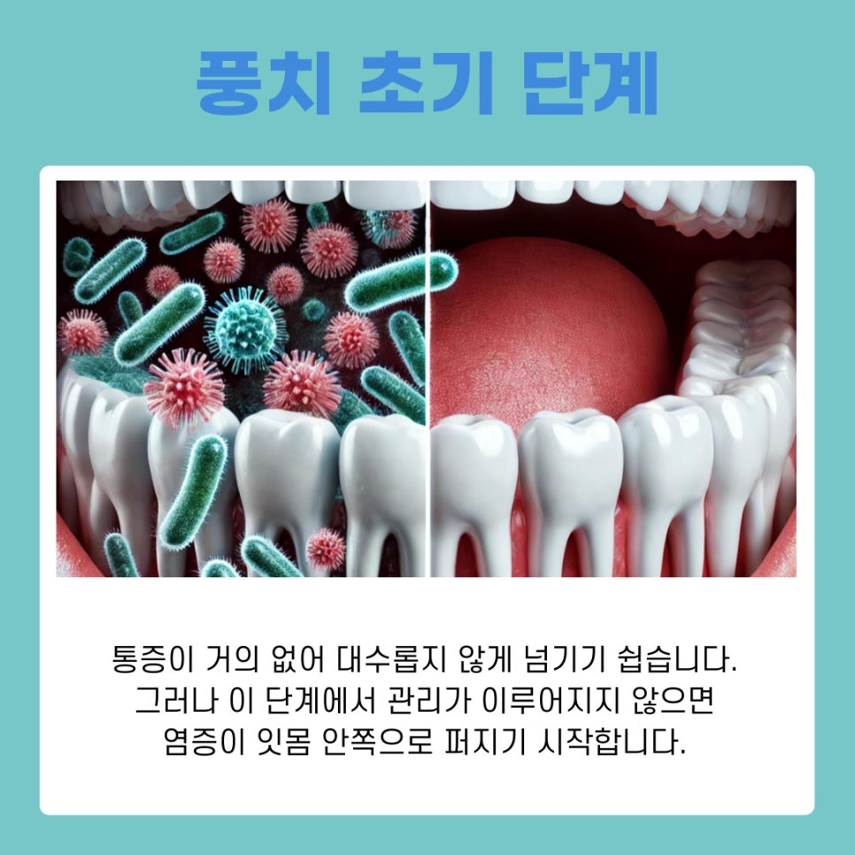 삼성동 치과 풍치 치료 방치하면 생길 수 있는 문제 관련 이미지 3