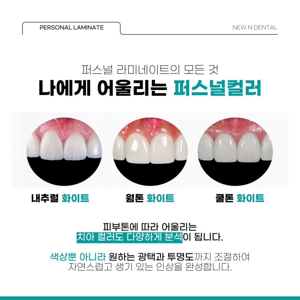 앞니심미치료로 되찾는 자연스러운 스마일 라인 관련 이미지 8