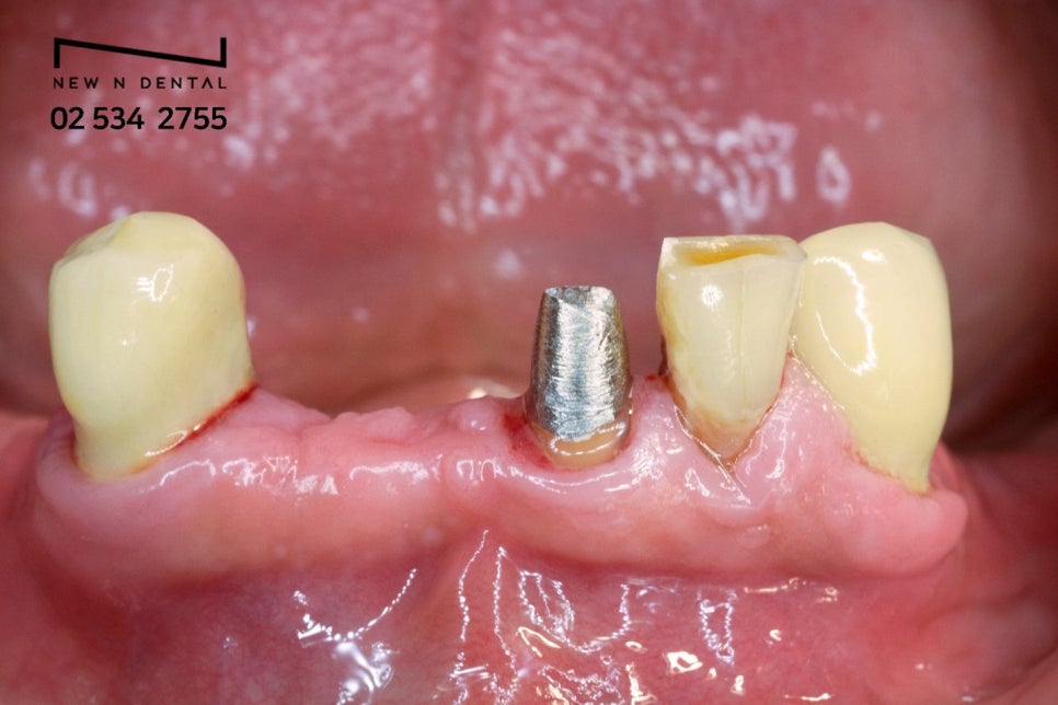 스트라우만임플란트 세계적인 이유 관련 이미지 6