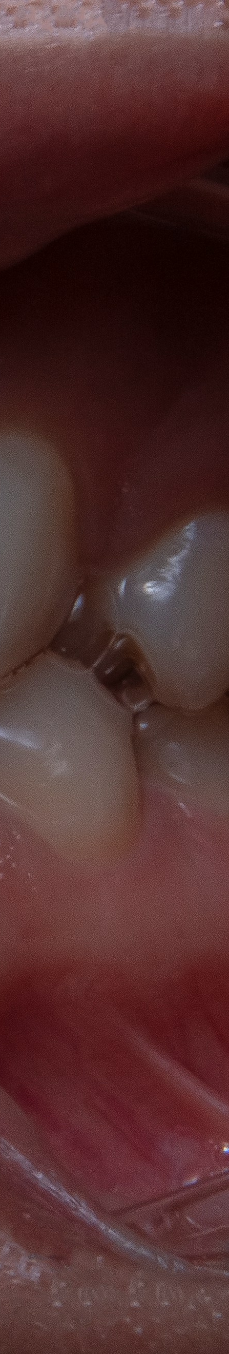 치아 미백 효과와 부작용 체크해야 할 사항 관련 이미지 25