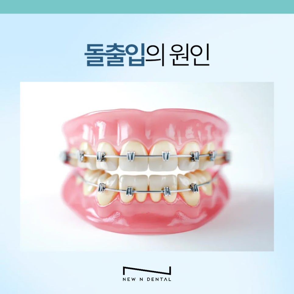 강남 돌출입치아교정 개선하려면 관련 이미지 4