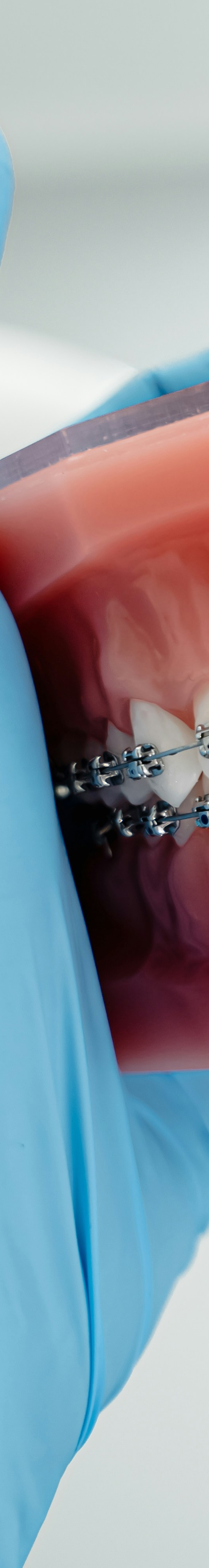 치아교정 후 유지 장치의 필요성 관련 이미지 10