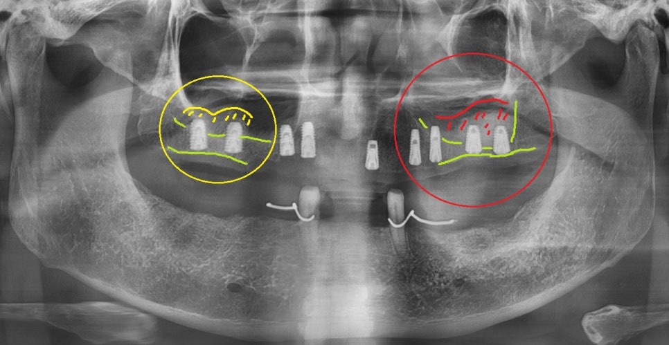 서초동임플란트치과 자연 치아가 탈락했다면 관련 이미지 7