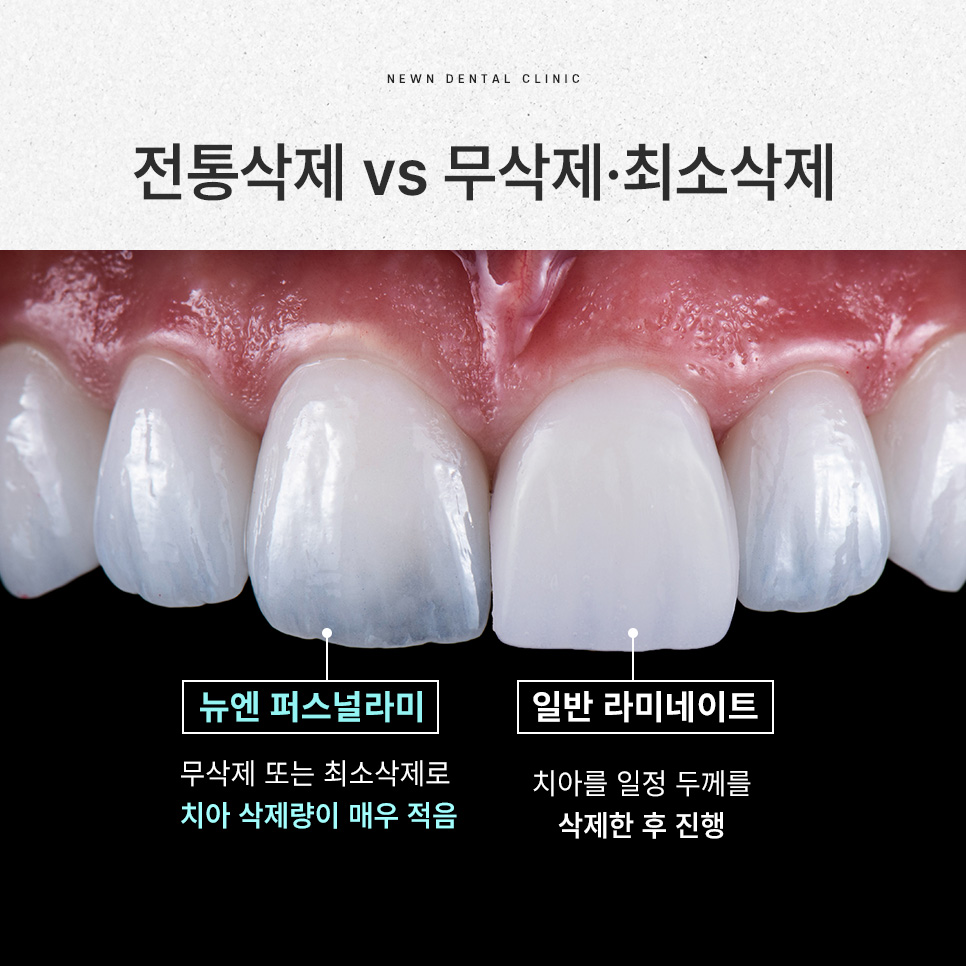 강남역 뉴엔치과 일반 라미네이트와 퍼스널라미의 차이점 관련 이미지 11