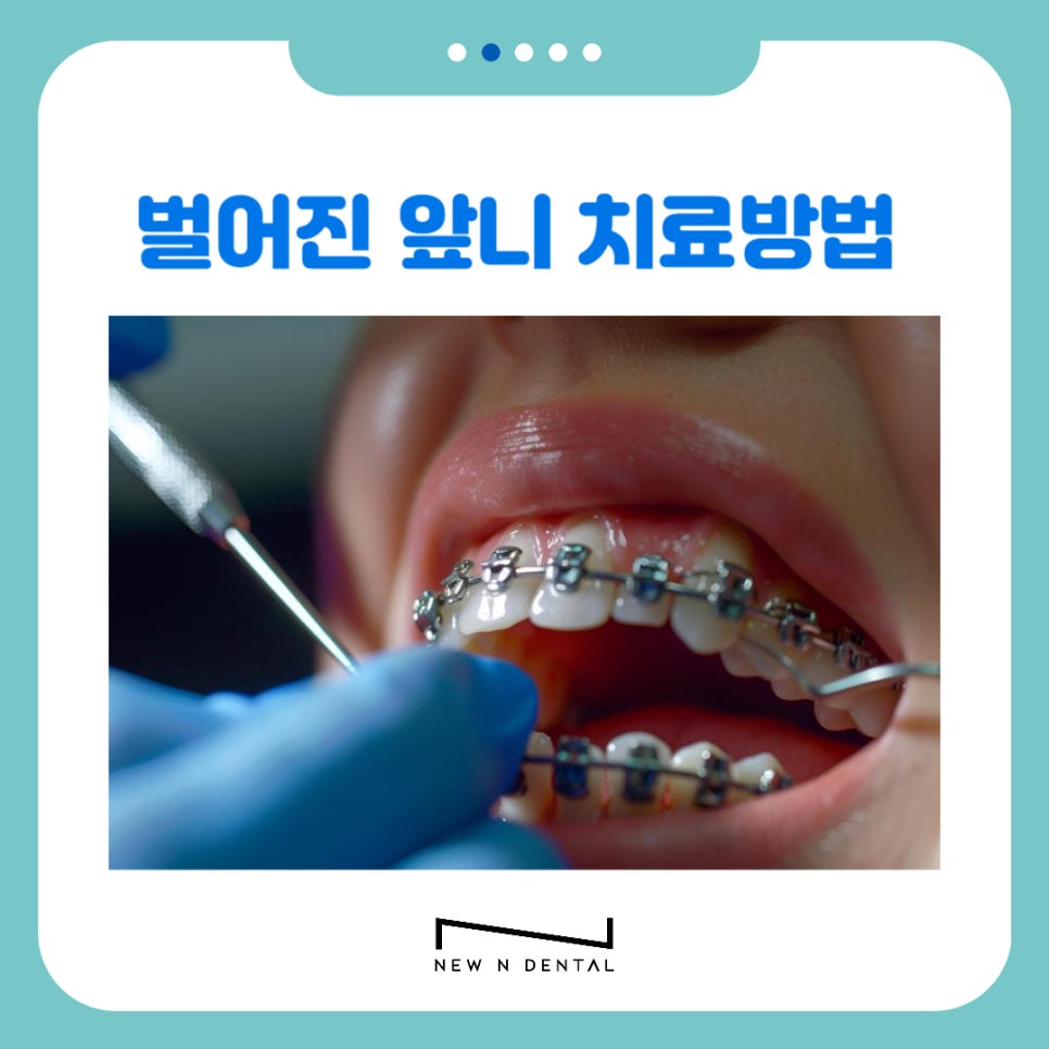 강남역치과 앞니 벌어짐 원인, 치료와 방법 관련 이미지 13