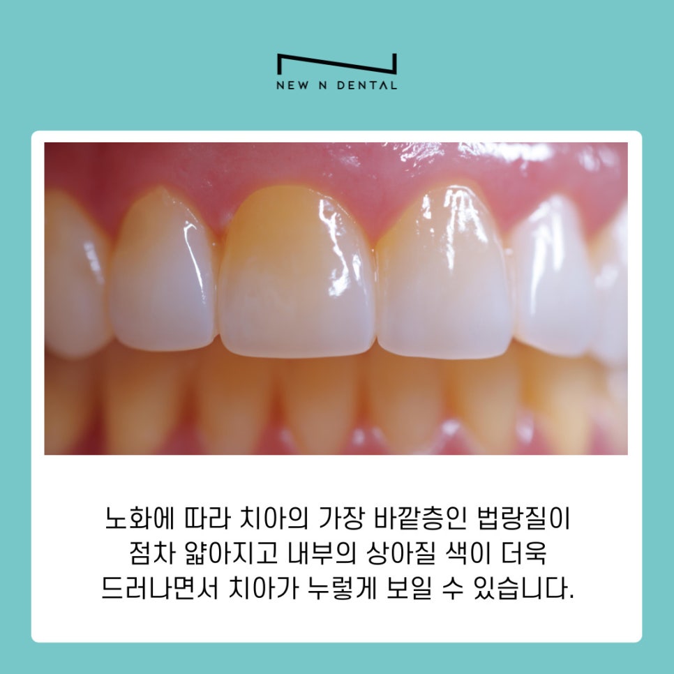 강남역 치아미백 밝은 미소를 위한 올바른 관리 방법 관련 이미지 7
