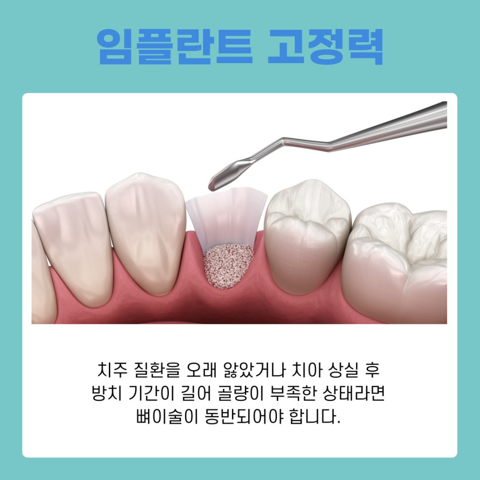 서초동임플란트치과와 함께하는 건강한 치아 회복과 관리 가이드 관련 이미지 4