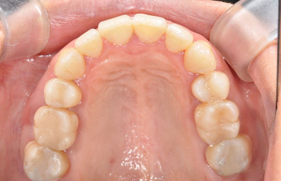 서울교정잘하는치과 컴퓨터분석 3D로 걱정없게 관련 이미지 5