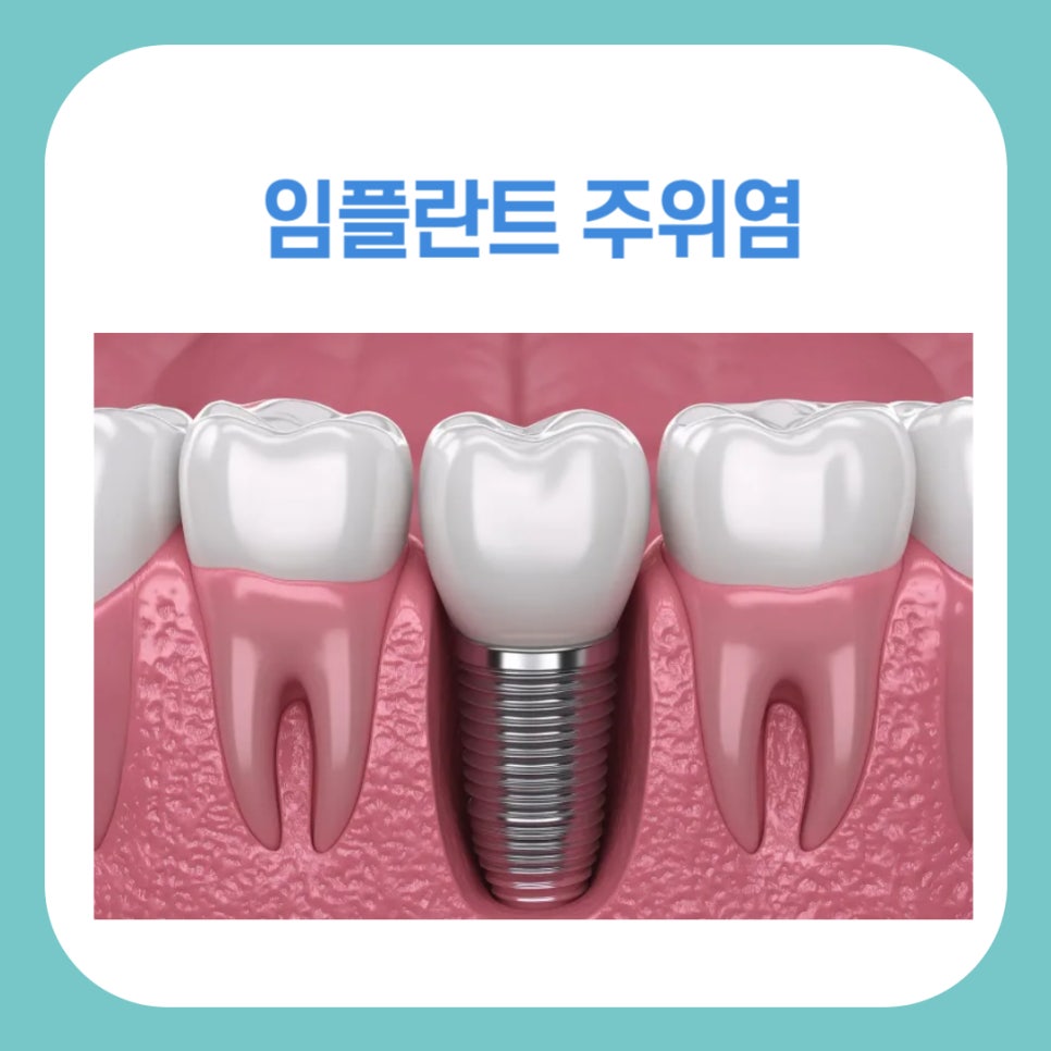 임플란트 주위염 원인과 예방방법 관련 이미지 1