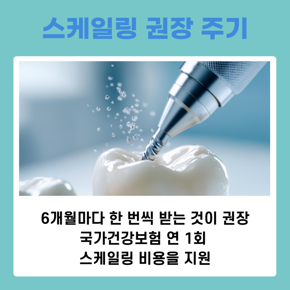 치아변색원인과 스케일링치료로 개선하는 방법 관련 이미지 7