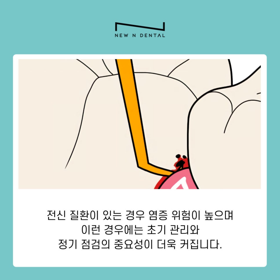 역삼동 임플란트 염증 초기 원인부터 예방법까지 한 번에 보기 관련 이미지 5