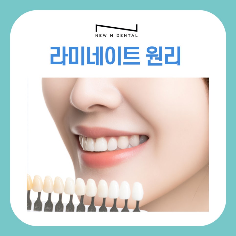 서초 라미네이트 심미를 완성하는 보철 치료의 원리와 기준 관련 이미지 2