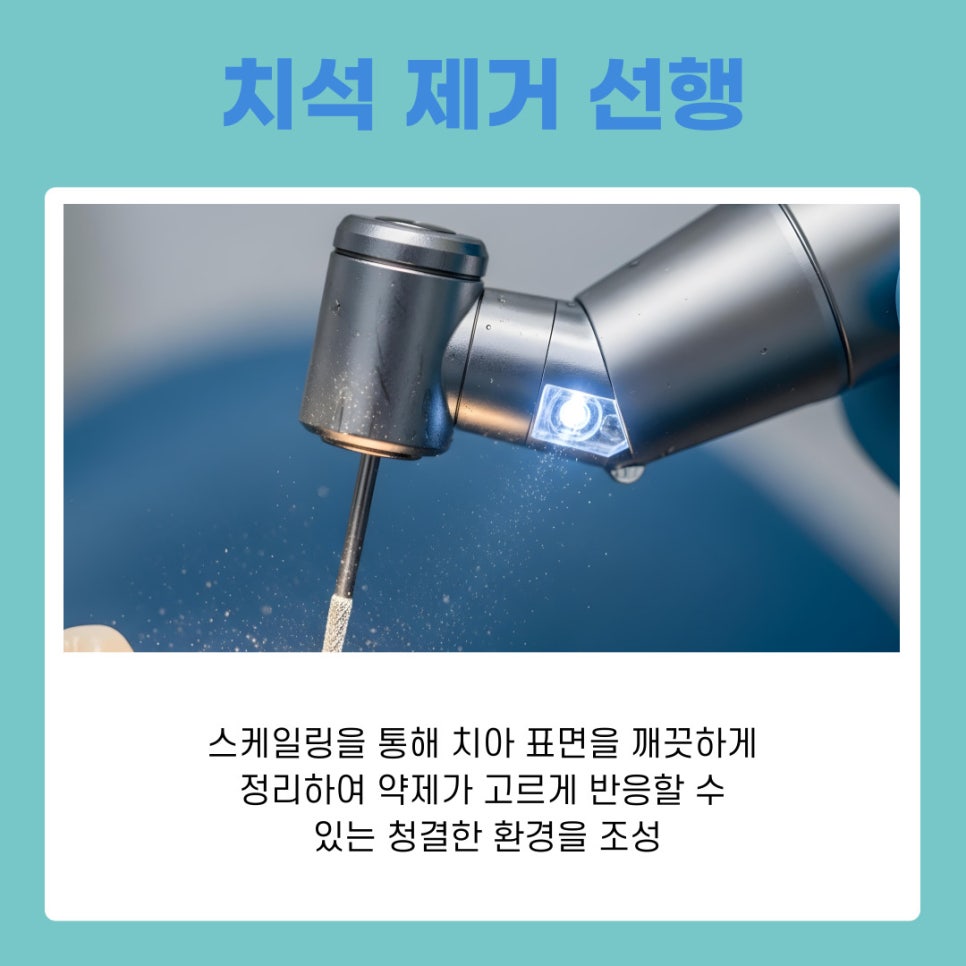 서초동 치아미백 원리와 시술 과정 정리 관련 이미지 8