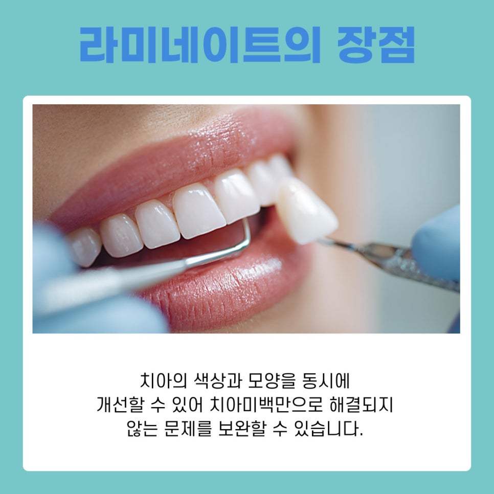 Gangnam Station Laminates: Understanding Aesthetic Treatment for a Natural Smile image 8