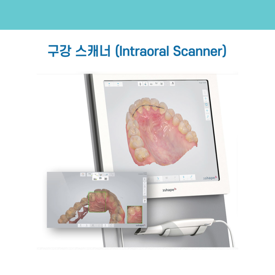 디지털 장비를 이용한 맞춤 치아 교정 관련 이미지 4