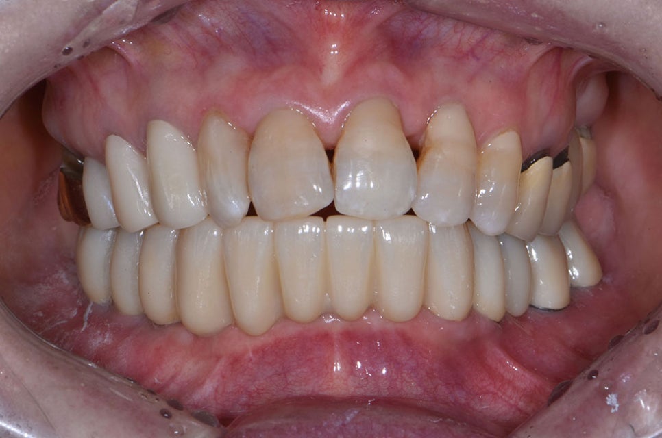 강남임플란트잘하는치과 찾는다면 관련 이미지 7