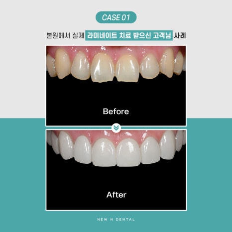 강남라미네이트 잘하는 곳 뉴엔치과 관련 이미지 8