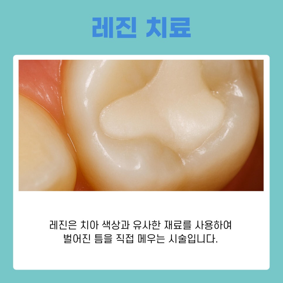 서초구치과에서 벌어진 앞니 교정 나에게 맞는 치료 알아보기 관련 이미지 4