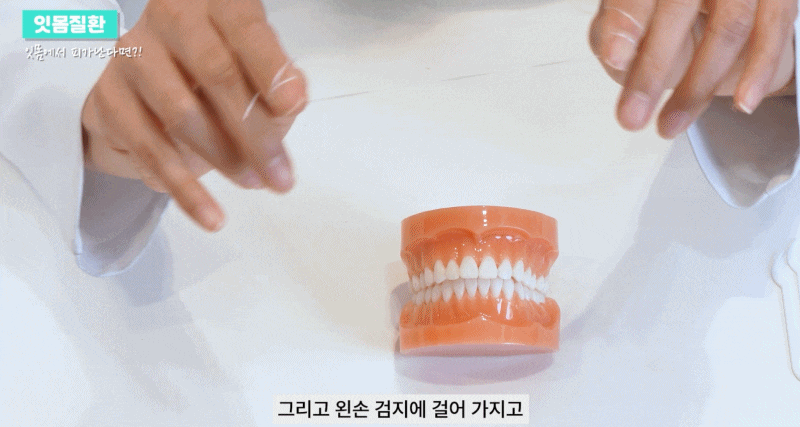 잇몸질환의 종류 출혈이 있을 때 예방방법 관련 이미지 13